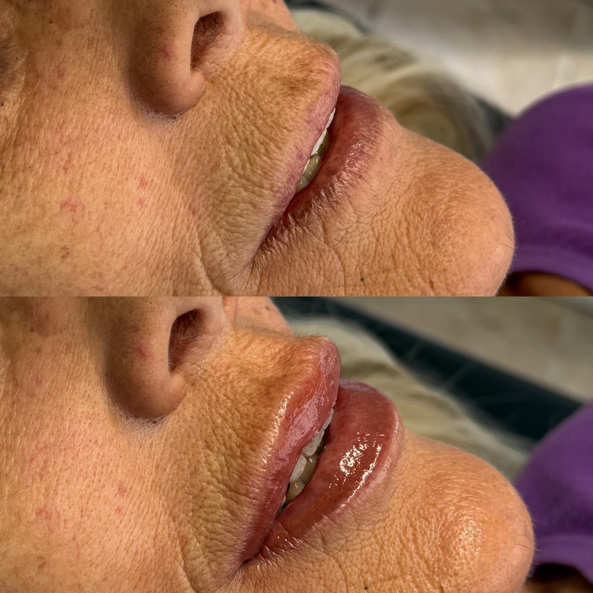 Before and after lip blush treatment